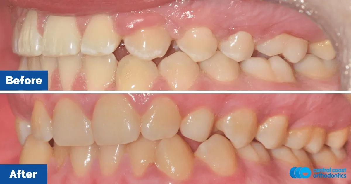 Before and after comparison, side view of the upper and lower teeth