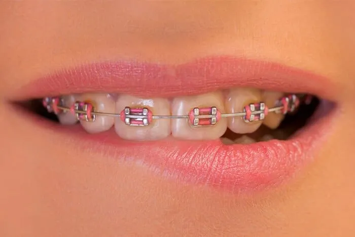 Close-up of a smile wearing braces with coloured elastics