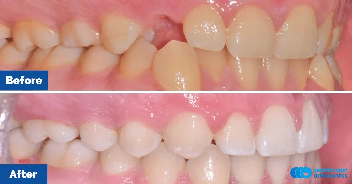 Before and after comparison, side view of the upper and lower teeth