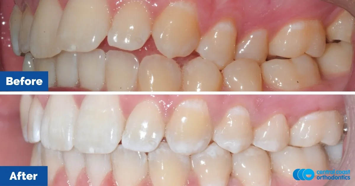 Before and after comparison, side view of the upper and lower teeth