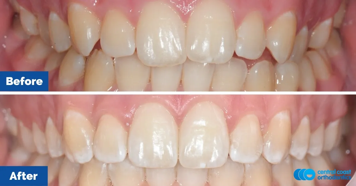 Before and after comparison, front view of the upper and lower teeth