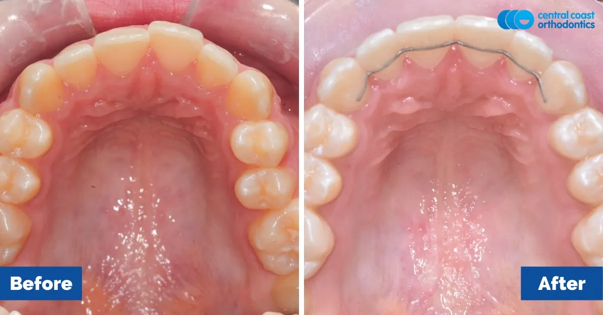 Before and after comparison, upper teeth viewed from below