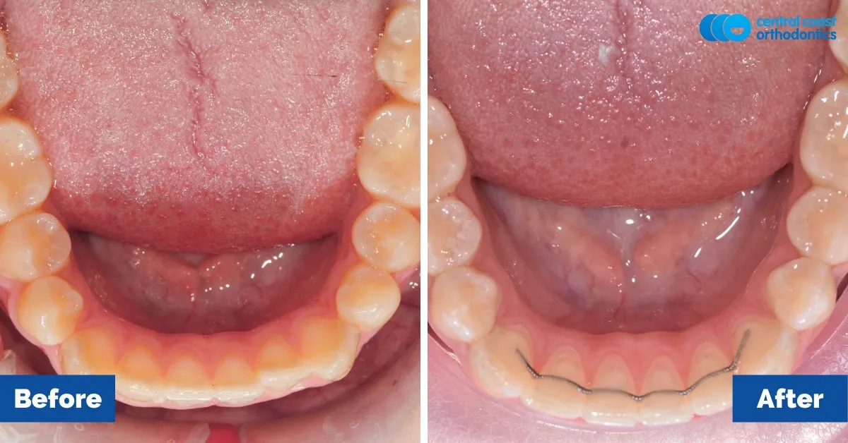 Before and after comparison, lower teeth viewed from above