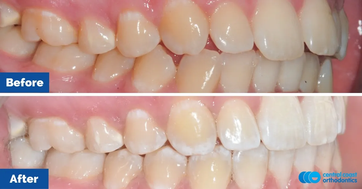 Before and after comparison, side view of the upper and lower teeth