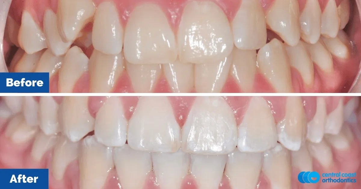 Before and after comparison, front view of the upper and lower teeth