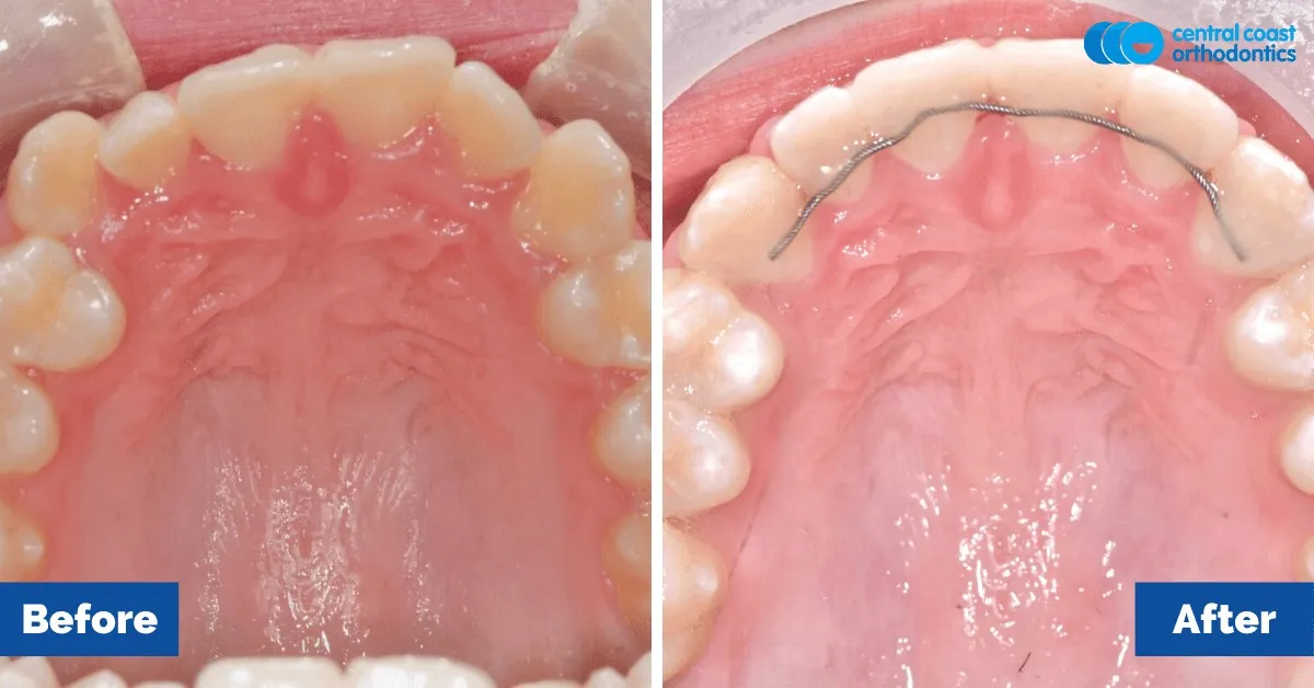 Before and after comparison, upper teeth viewed from below