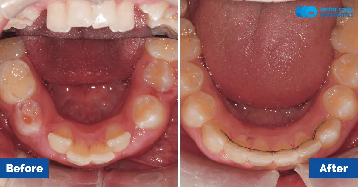 Before and after comparison, lower teeth viewed from above