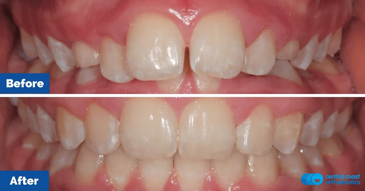 Before and after comparison, front view of the upper and lower teeth