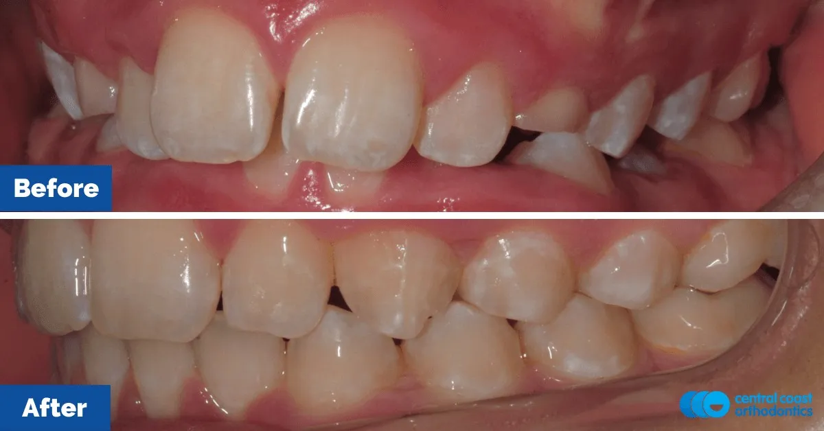 Before and after comparison, front view of the upper and lower teeth