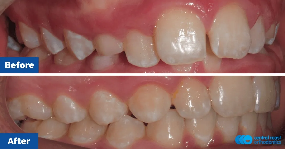 Before and after comparison, side view of the upper and lower teeth