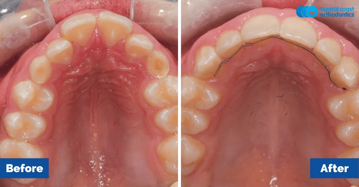 Before and after comparison, upper teeth viewed from below