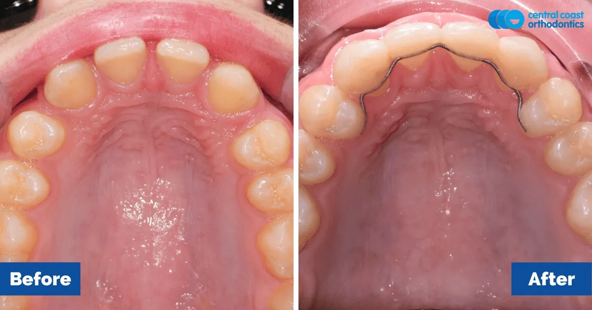Before and after comparison, upper teeth viewed from below