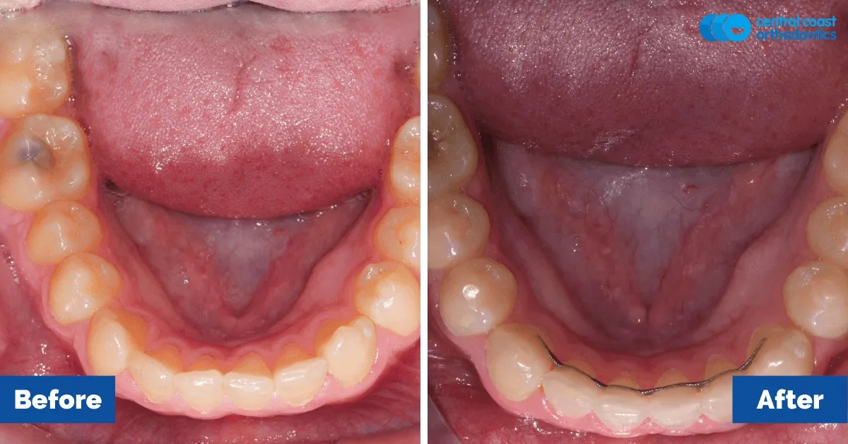 Before and after comparison, lower teeth viewed from above