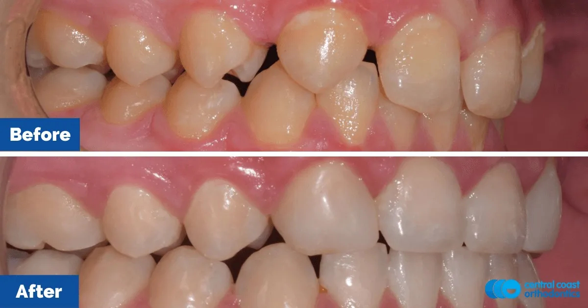 Before and after comparison, side view of the upper and lower teeth