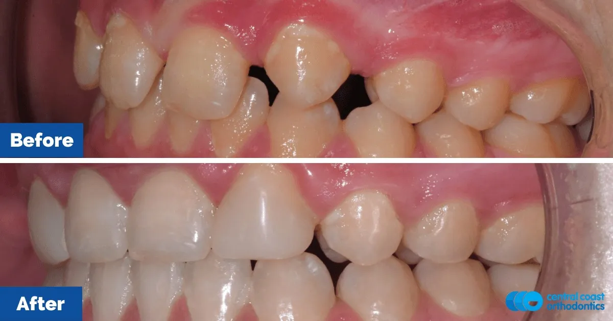 Before and after comparison, side view of the upper and lower teeth