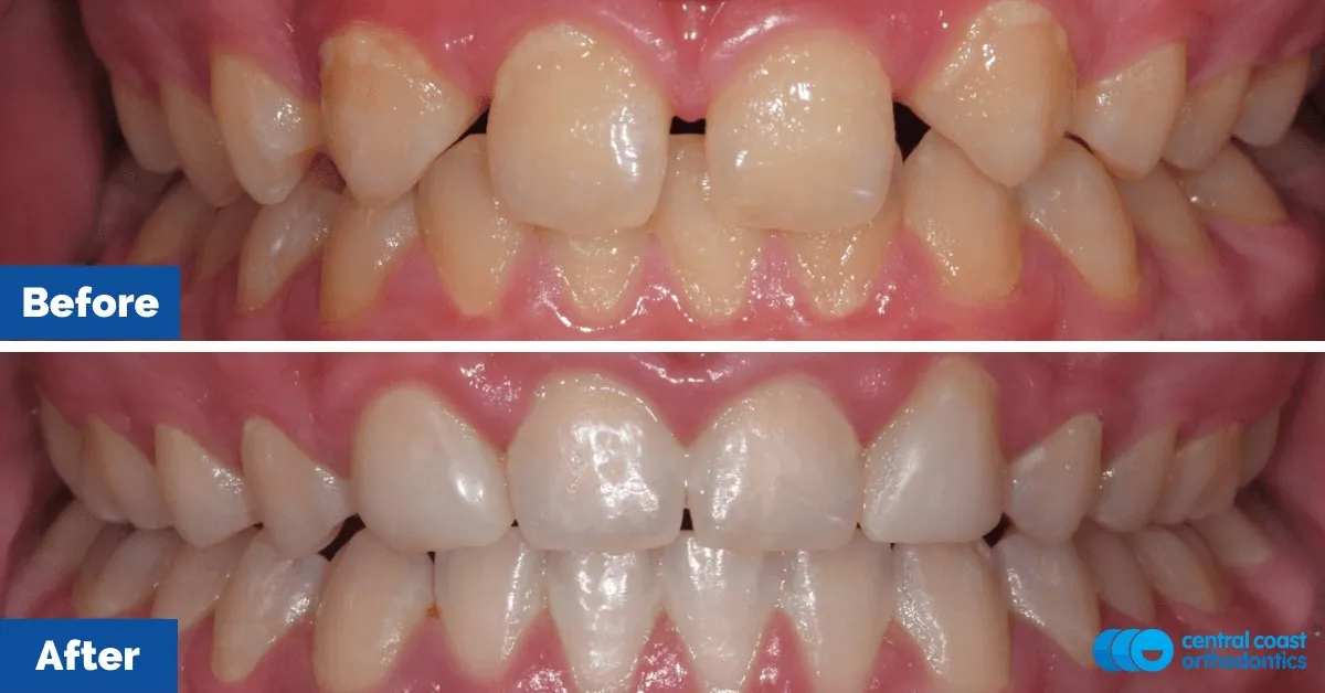 Before and after comparison, front view of the upper and lower teeth