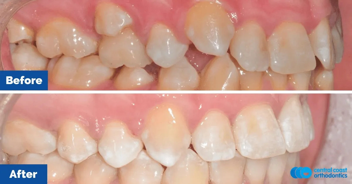Before and after comparison, side view of the upper and lower teeth