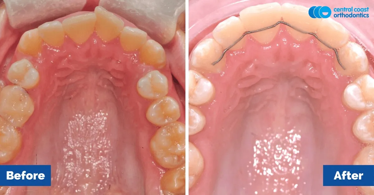 Before and after comparison, upper teeth viewed from below