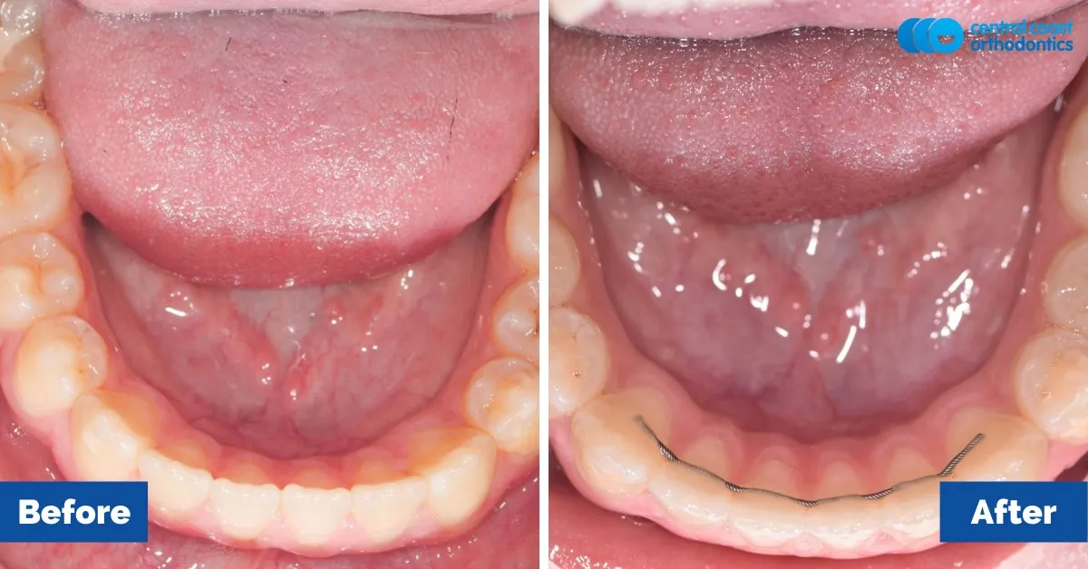 Before and after comparison, lower teeth viewed from above