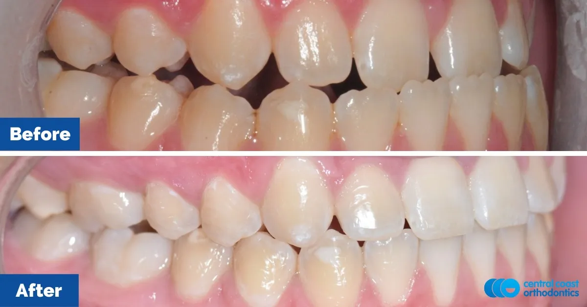 Before and after comparison, side view of the upper and lower teeth