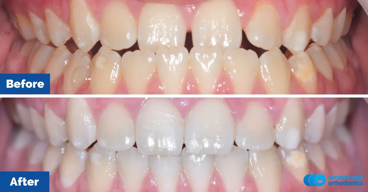 Before and after comparison, front view of the upper and lower teeth