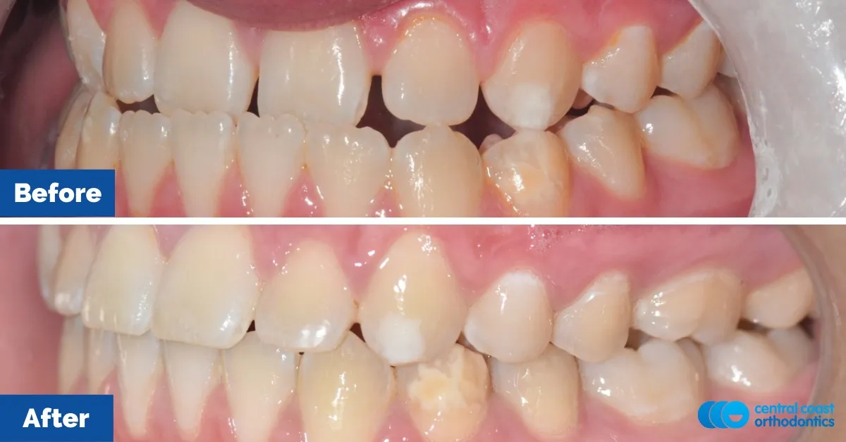 Before and after comparison, side view of the upper and lower teeth