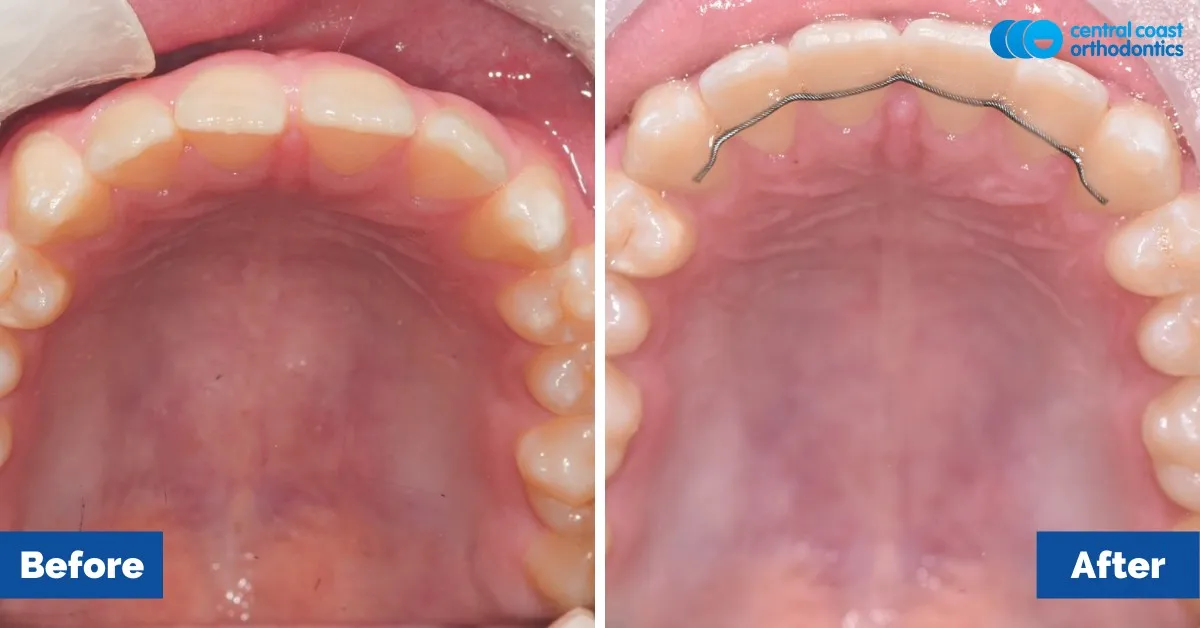 Before and after comparison, upper teeth viewed from below