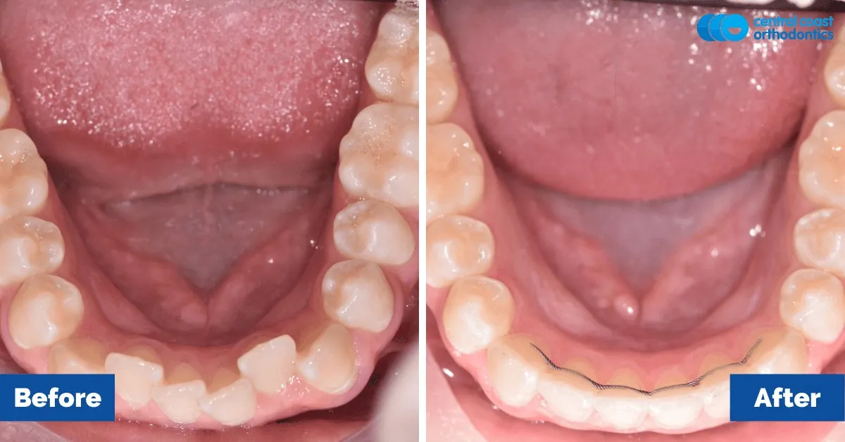 Before and after comparison, lower teeth viewed from above
