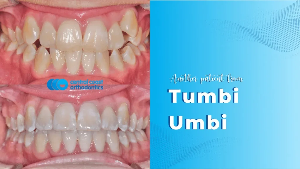 Before and after photographs of a Central Coast Orthodontics patient's teeth, labelled Tumbi Umbi