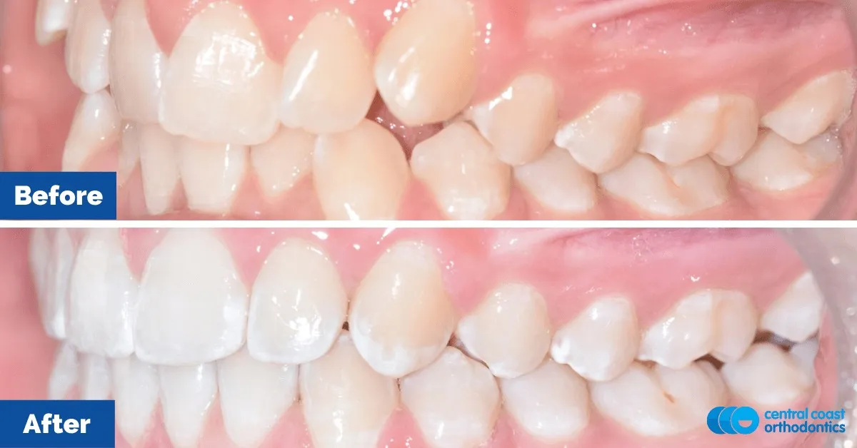 Before and after comparison, side view of the upper and lower teeth
