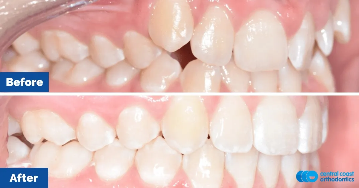 Before and after comparison, side view of the upper and lower teeth