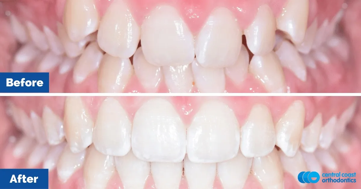 Before and after comparison, front view of the upper and lower teeth