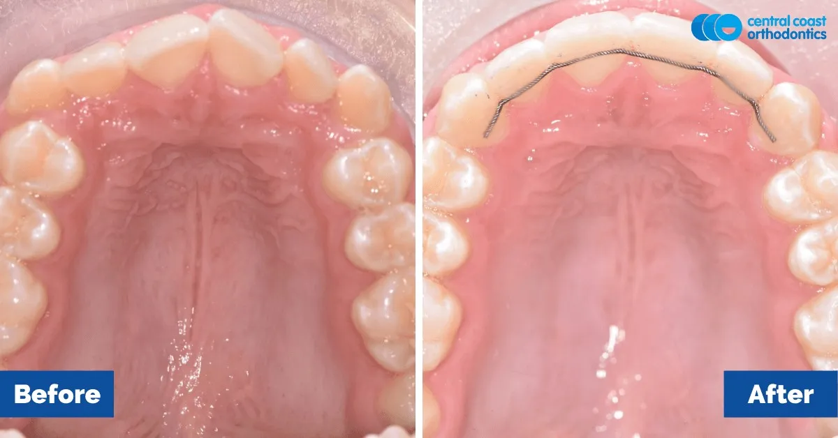 Before and after comparison, upper teeth viewed from below