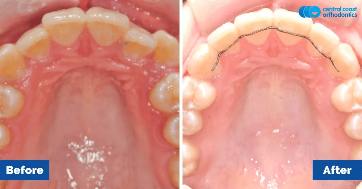 Before and after comparison, upper teeth viewed from below