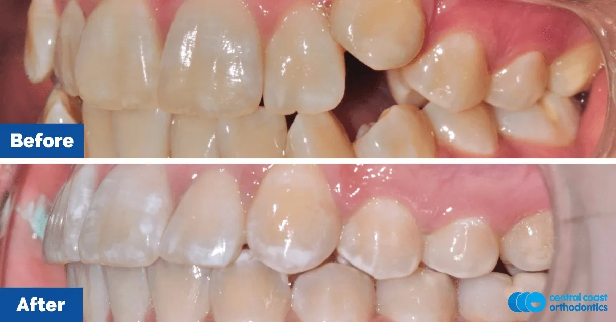 Before and after comparison, side view of the upper and lower teeth