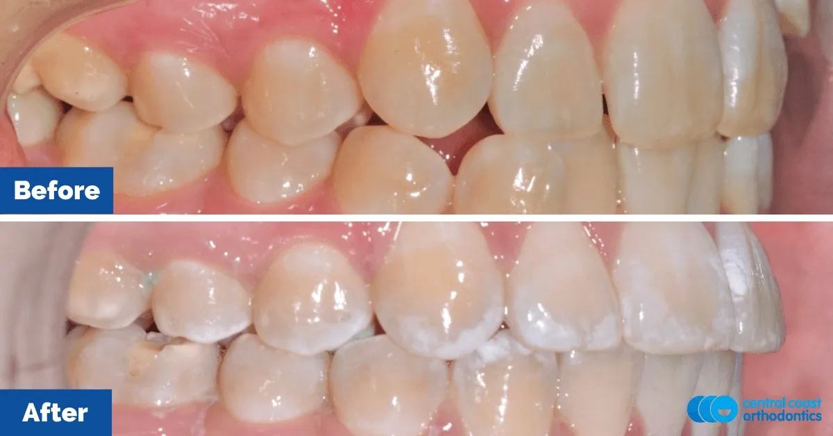 Before and after comparison, front view of the upper and lower teeth