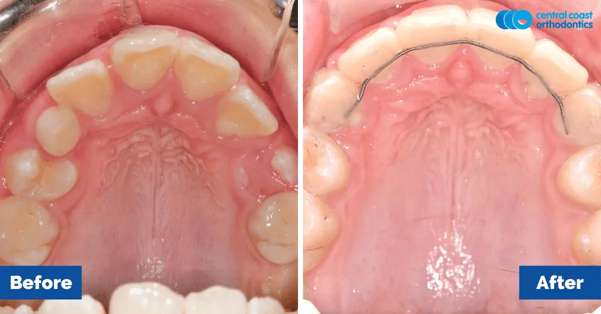 Before and after comparison, upper teeth viewed from below