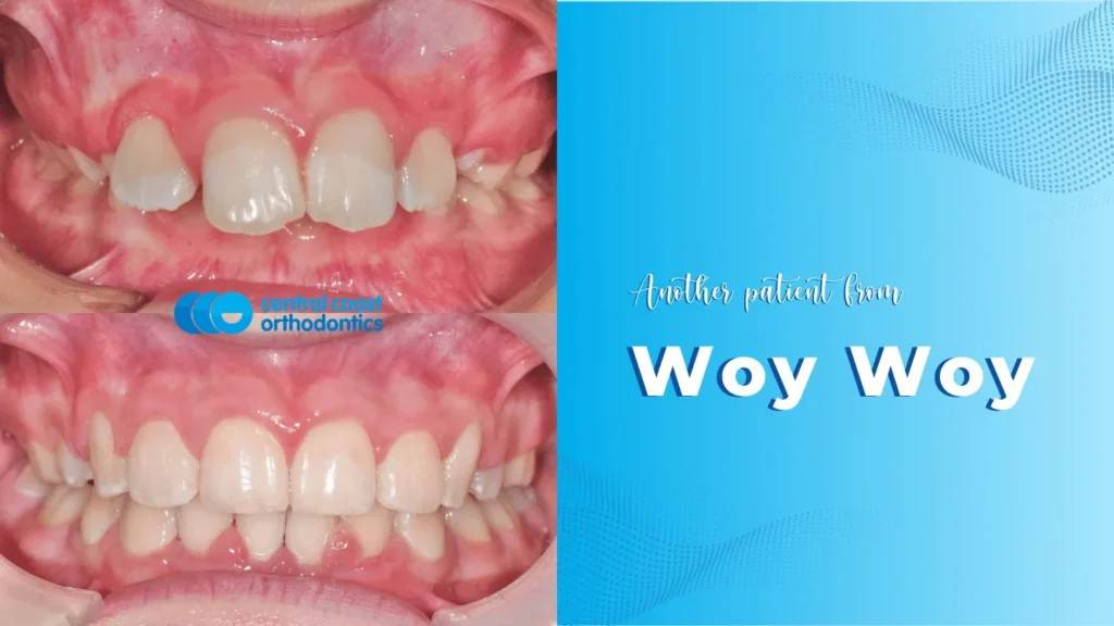 Before and after photographs of a Central Coast Orthodontics patient's teeth, labelled Woy Woy