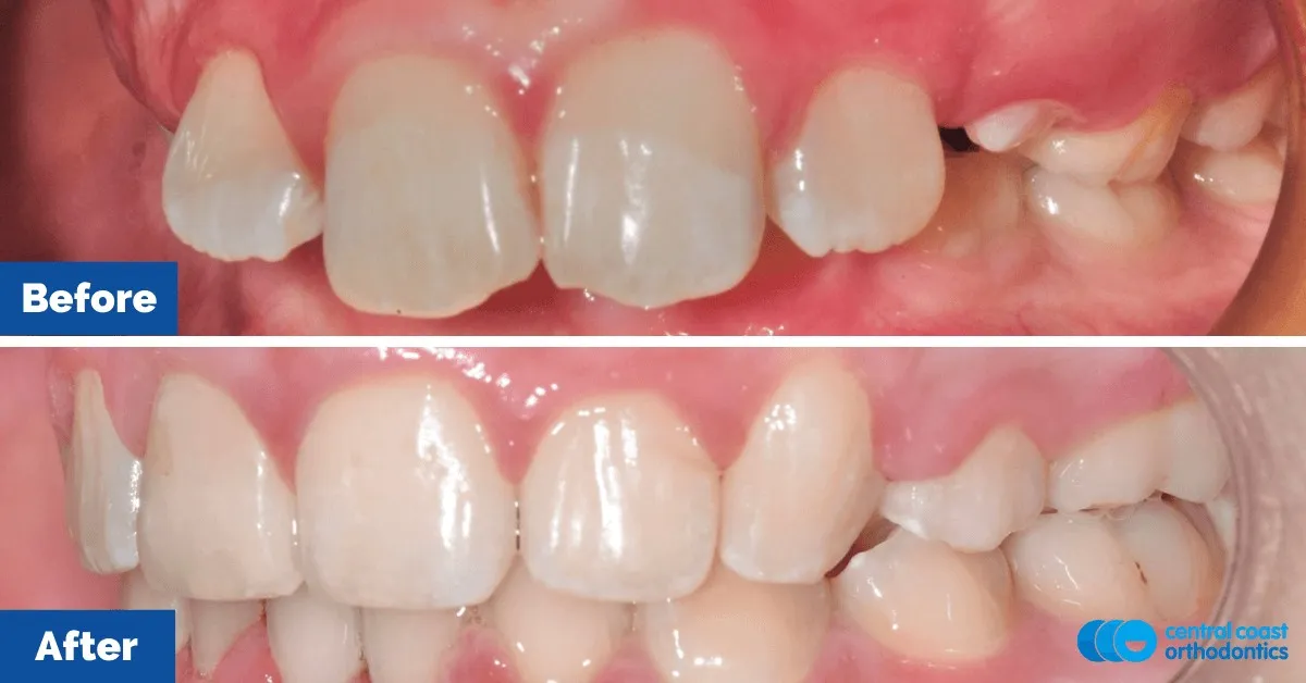 Before and after comparison, front view of the upper and lower teeth