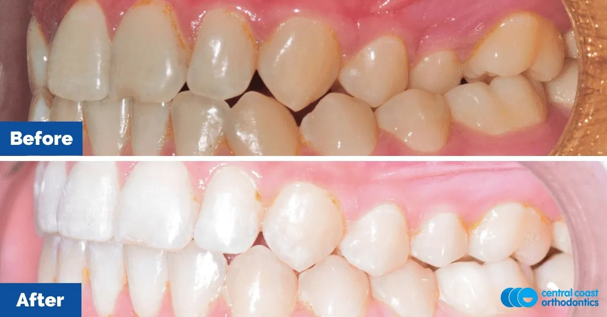 Before and after comparison, side view of the upper and lower teeth