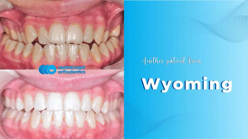 Before and after photographs of a Central Coast Orthodontics patient's teeth, labelled Wyoming