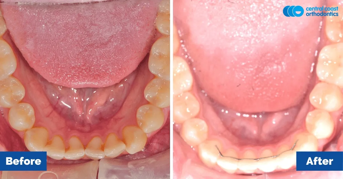 Before and after comparison, lower teeth viewed from above
