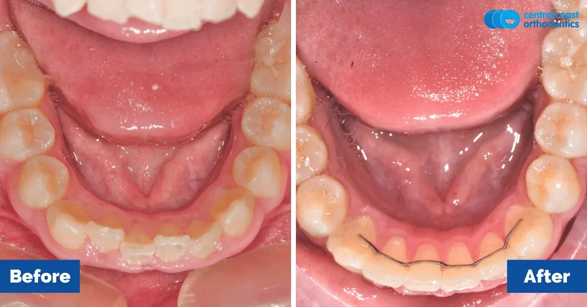 Before and after comparison, lower teeth viewed from above
