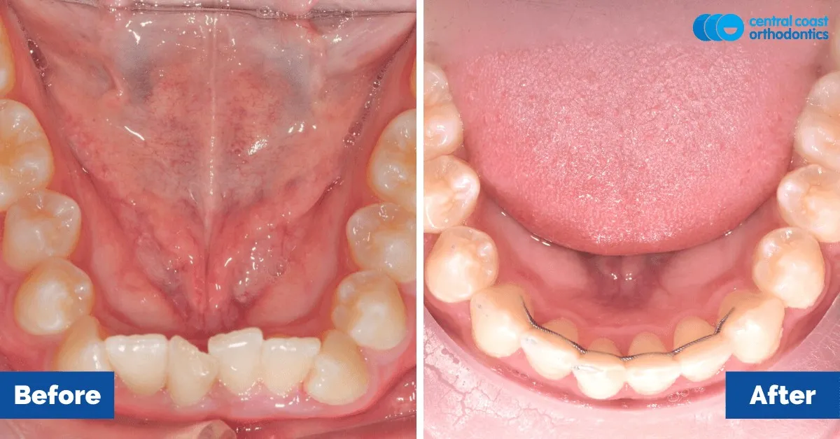 Before and after comparison, lower teeth viewed from above