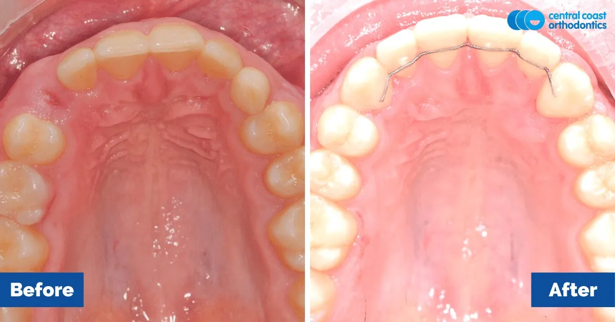 Before and after comparison, upper teeth viewed from below