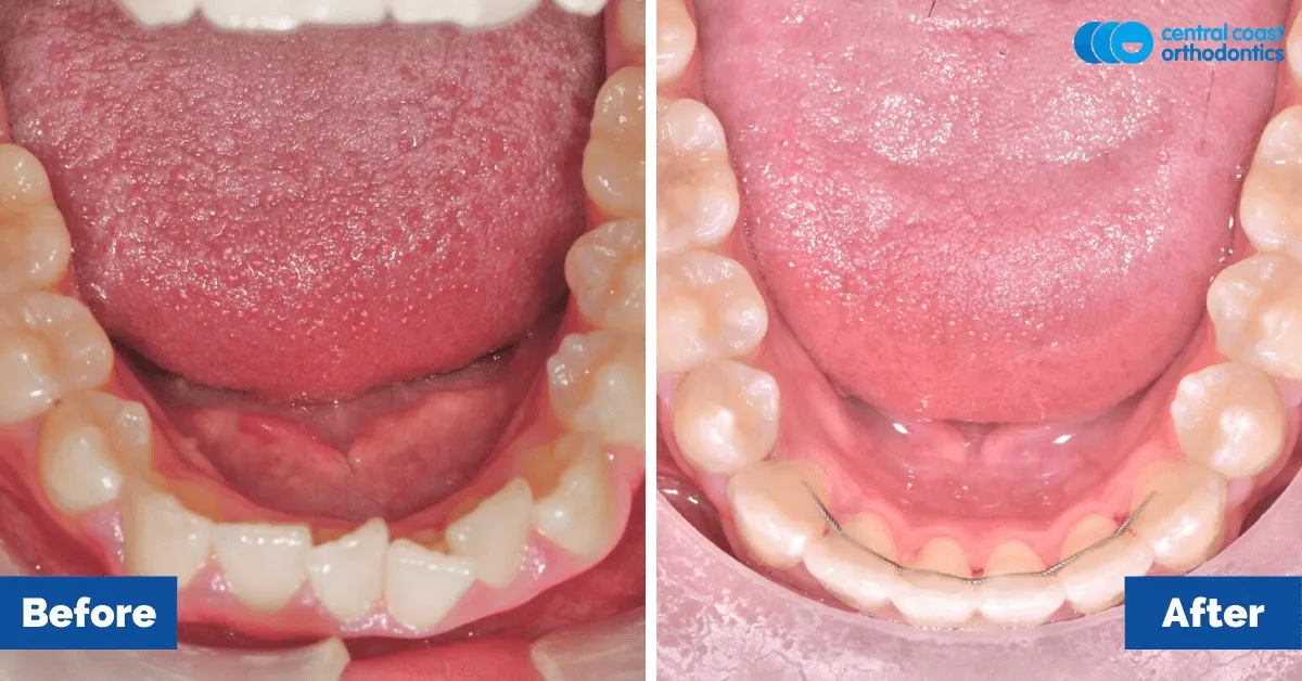 Before and after comparison, lower teeth viewed from above