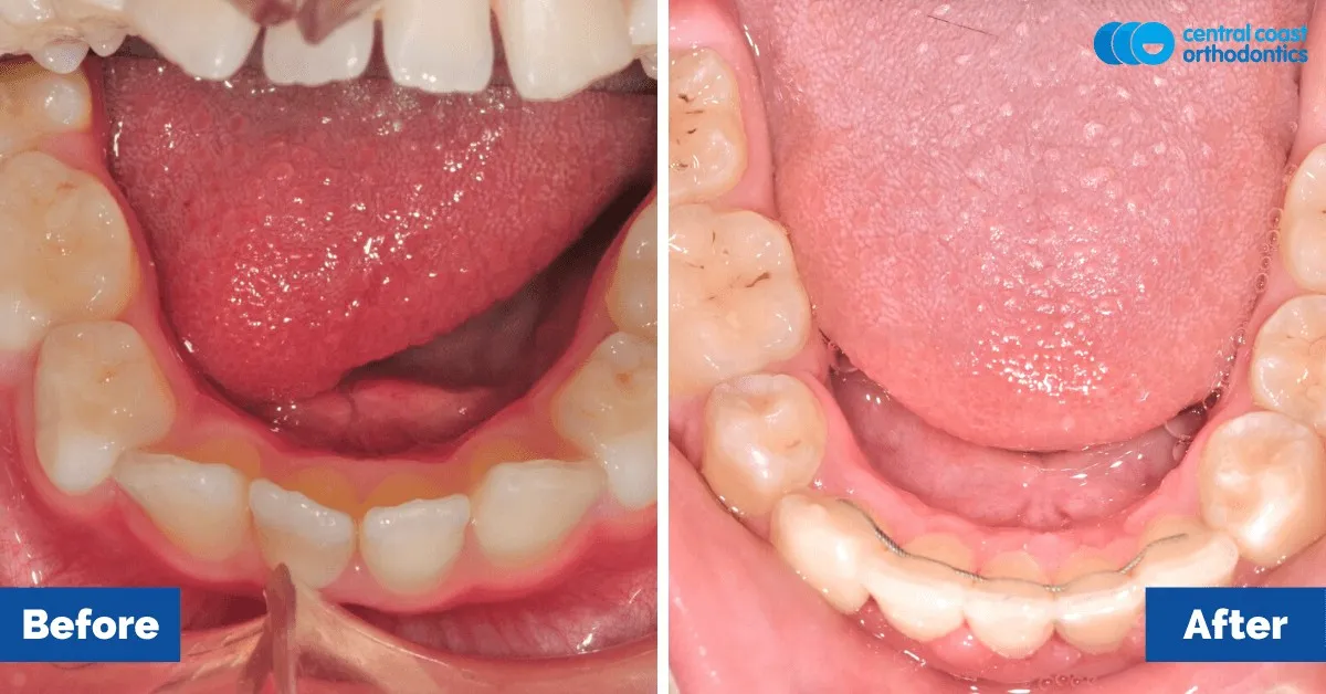 Before and after comparison, lower teeth viewed from above