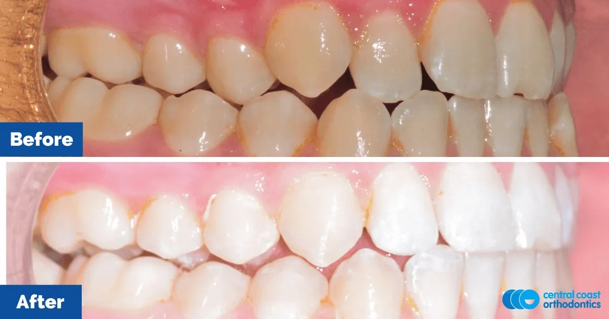 Before and after comparison, front view of the upper and lower teeth