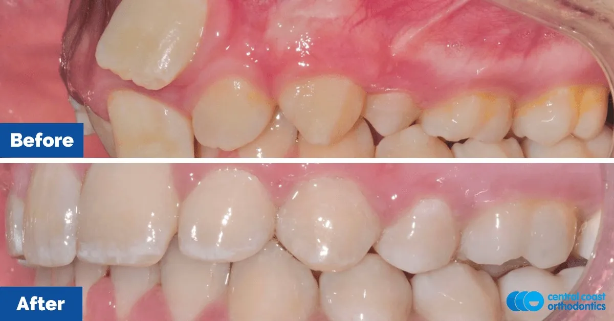 Before and after comparison, side view of the upper and lower teeth