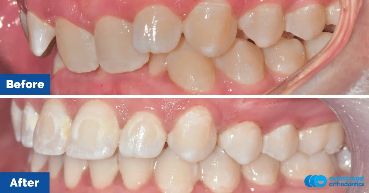 Before and after comparison, side view of the upper and lower teeth